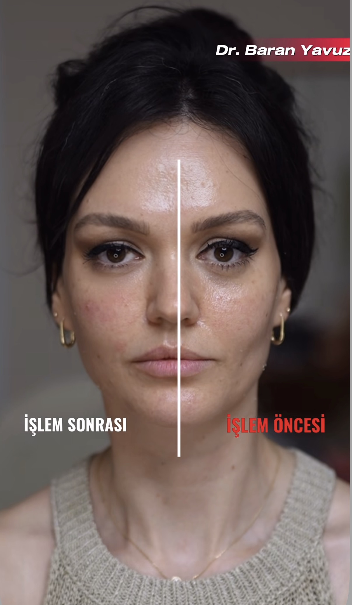 Bay Lift öncesi ve sonrası